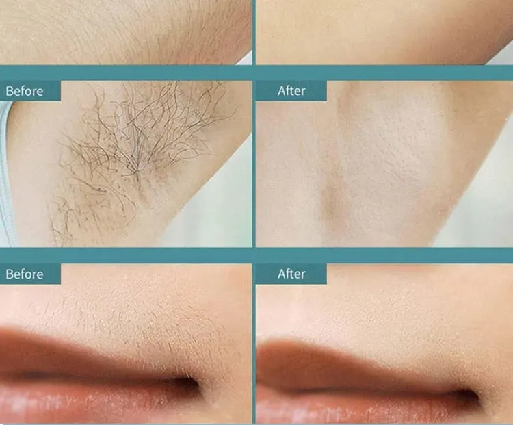 IPL Laser Hair Removal Device